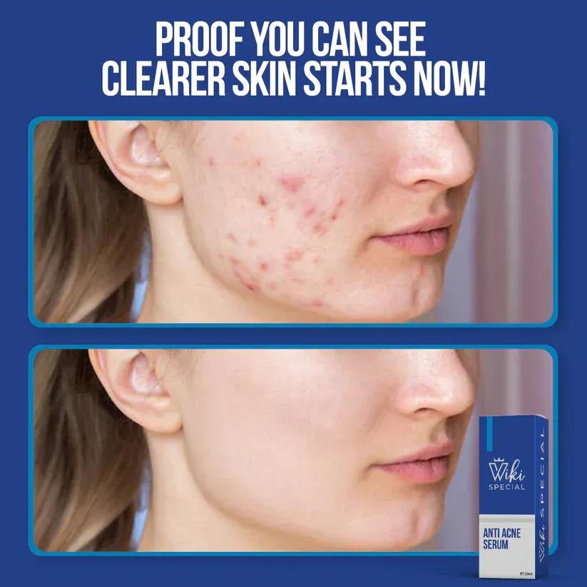 Clear Glow Anti-Acne Face Serum | Advanced Blemish Control & Skin Brightening Formula