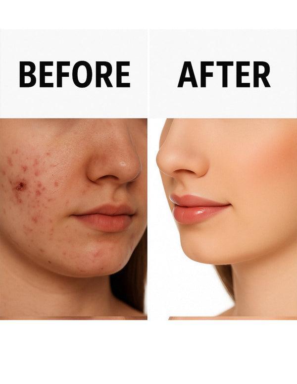 Clear Skin Hydrating Acne Shield Gel | 50ml Gentle Exfoliating Formula